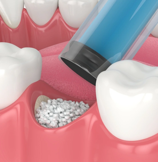 3D illustration of dental bone grafting material being placed in the jaw to rebuild bone and prepare for successful dental implant placement at South Arlington Smiles in Arlington, TX.