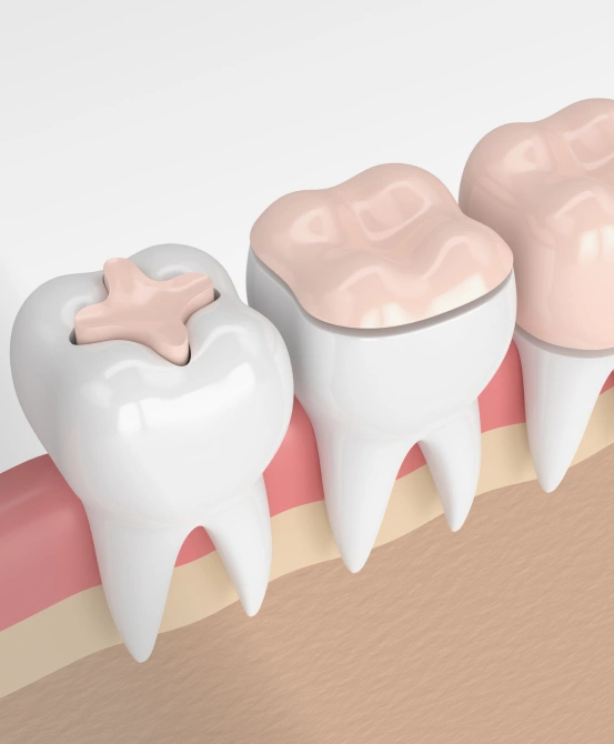A 3D model of three molar teeth on a pink gum line. The first tooth shows a pink dental inlay fitting perfectly inside the biting surface between the cusps; the second tooth shows a pink dental onlay covering the entire upper chewing surface and extending over the cusps.