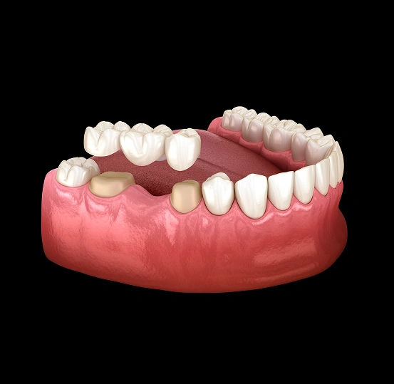 3D illustration of a custom dental bridge replacing a missing tooth to restore a complete, natural-looking smile at South Arlington Smiles in Arlington, TX.