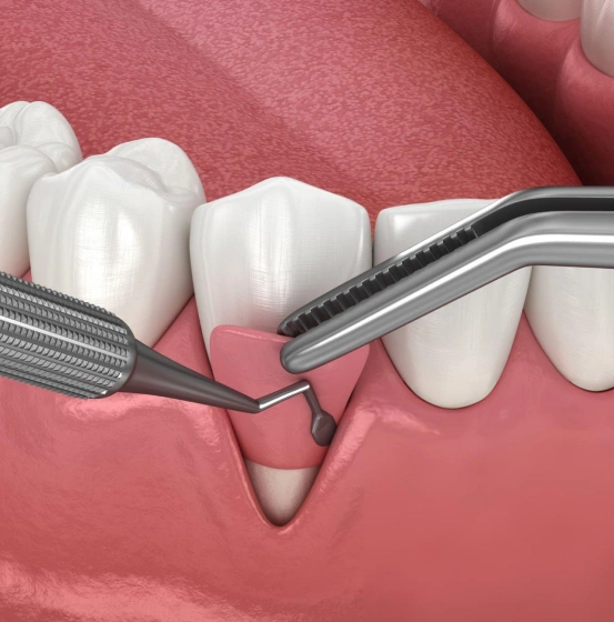 3D dental model demonstrating gum grafting surgery to treat gum recession and protect tooth roots.